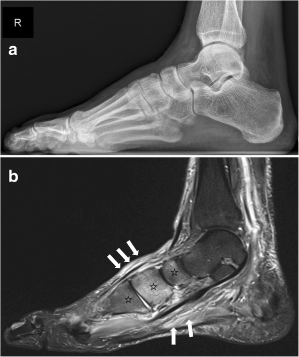 External fixation for Charcot ankle reconstruction