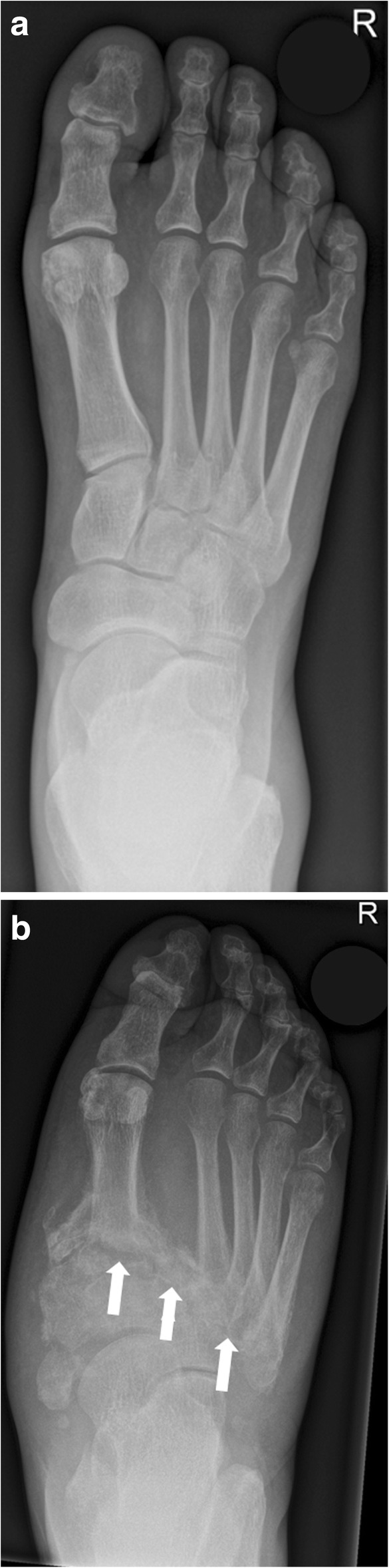 MRI of Charcot foot showing bone marrow edema