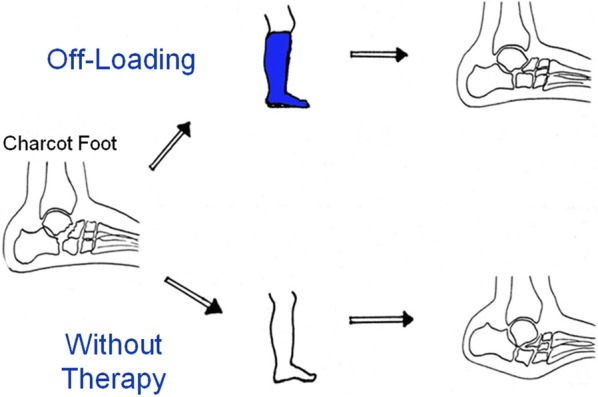 Total contact cast and offloading for acute Charcot foot