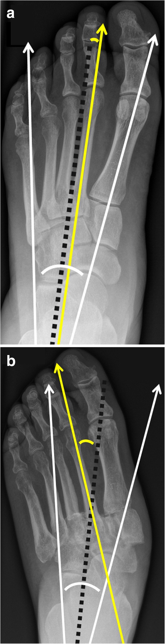 Charcot reconstructive arthrodesis with plate fixation