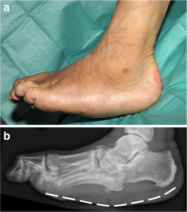 Rocker-bottom deformity from Charcot midfoot collapse