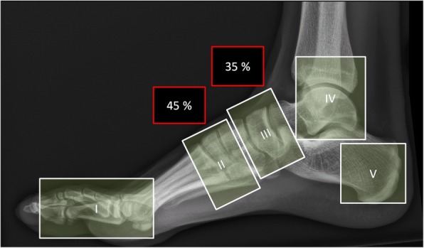 Sanders and Frykberg anatomic classification zones of Charcot foot