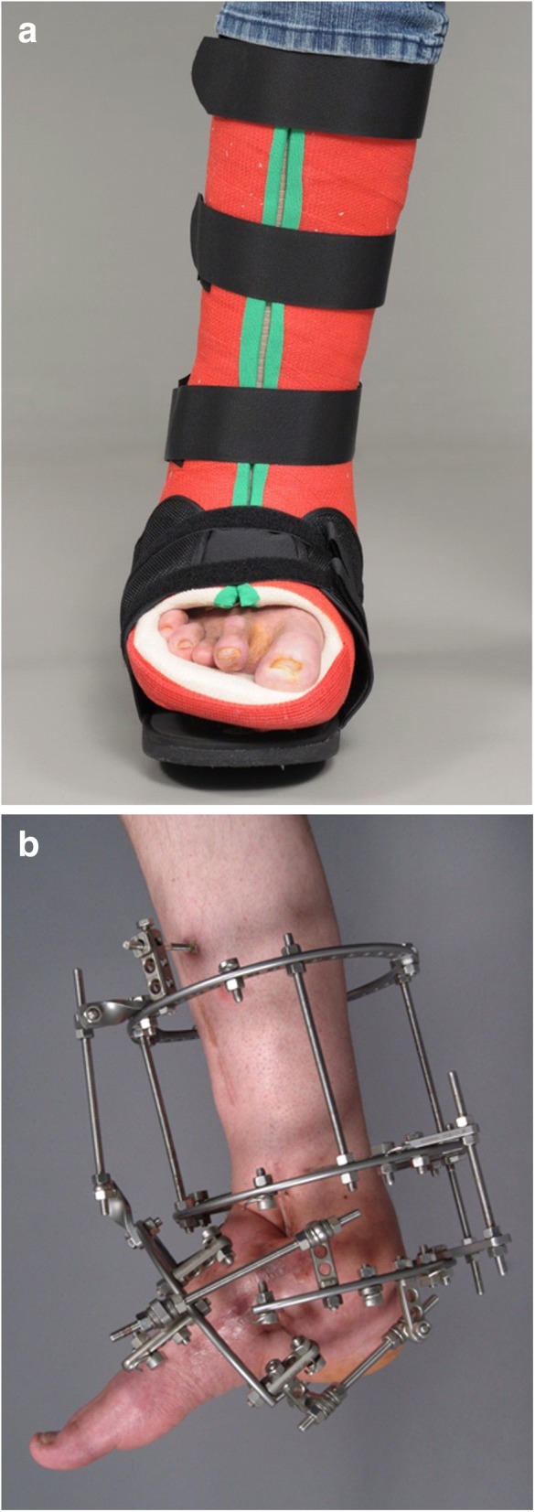 Combined TCC and fixateur for Charcot management