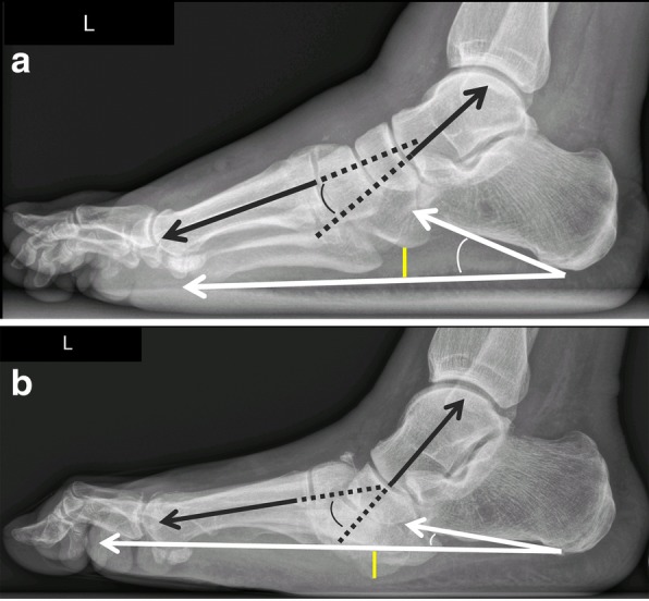 Infrared thermometry comparing temperature between Charcot and contralateral foot