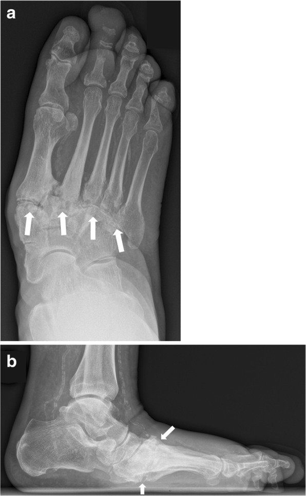 Charcot Zone II involvement at the Lisfranc joint