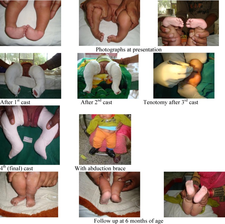 Bilateral clubfoot before and during serial Ponseti casting