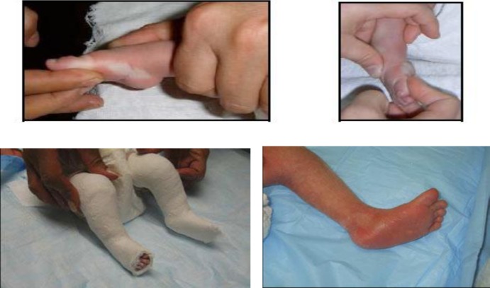 Cavus correction as the first step in Ponseti method