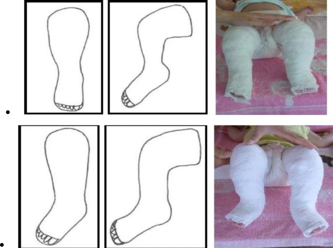 Serial Ponseti casting progression for clubfoot correction