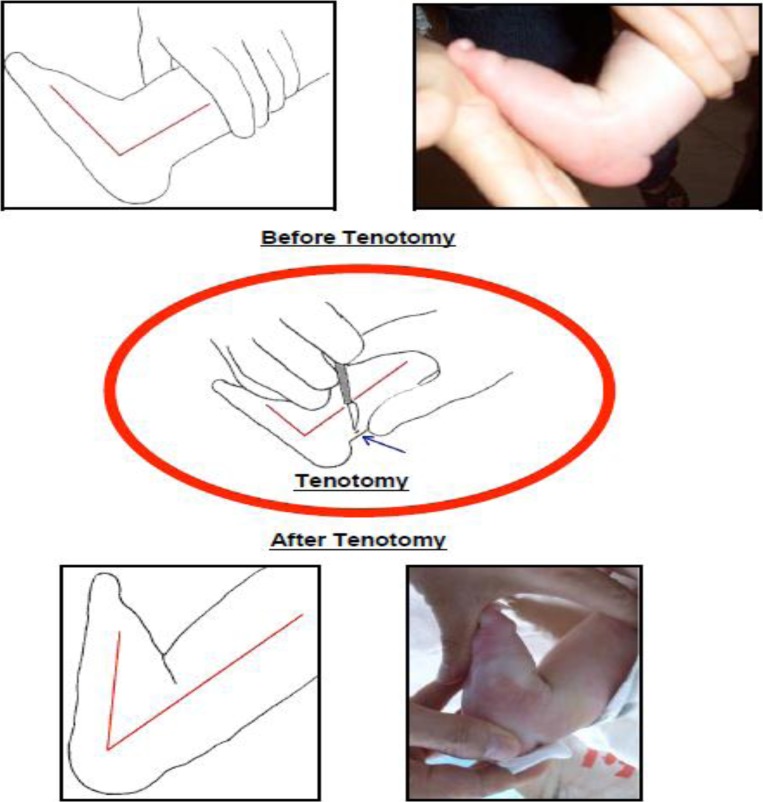 Percutaneous Achilles tenotomy for clubfoot equinus correction