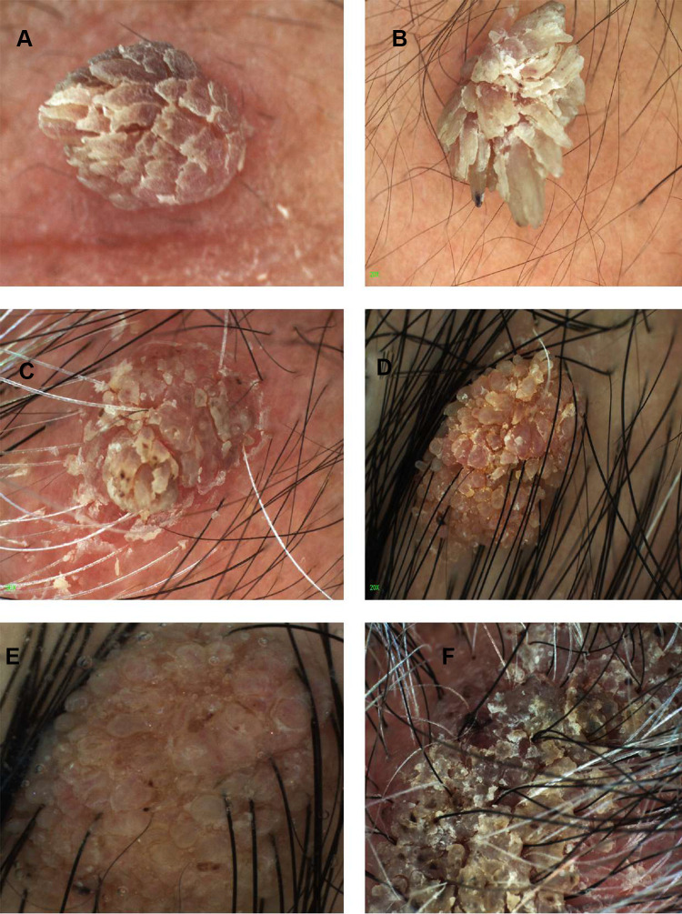 Dermoscopic view of a common wart showing thrombosed capillaries