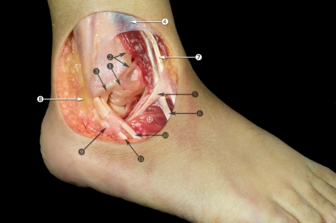 Lateral ankle ligaments showing the ATFL, CFL, and PTFL