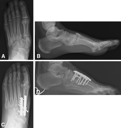 Lisfranc injury radiograph showing tarsometatarsal diastasis