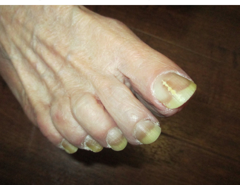 Dermatophytoma within the toenail plate