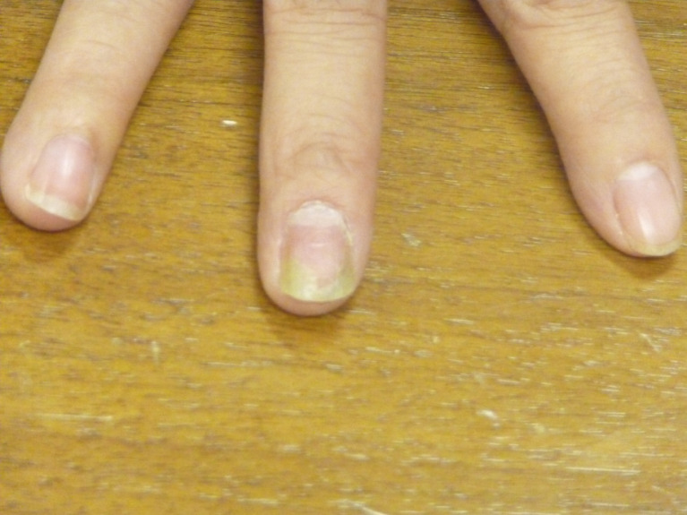 Distal lateral subungual onychomycosis of the toenail