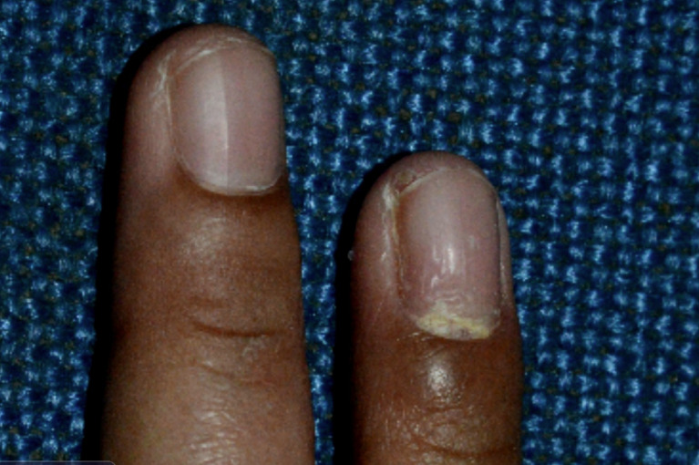 Proximal subungual onychomycosis