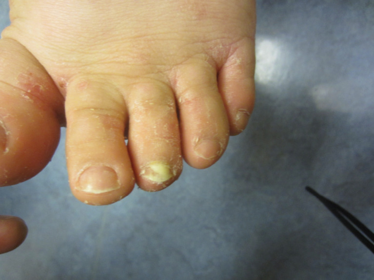 Tinea pedis moccasin distribution with concurrent onychomycosis