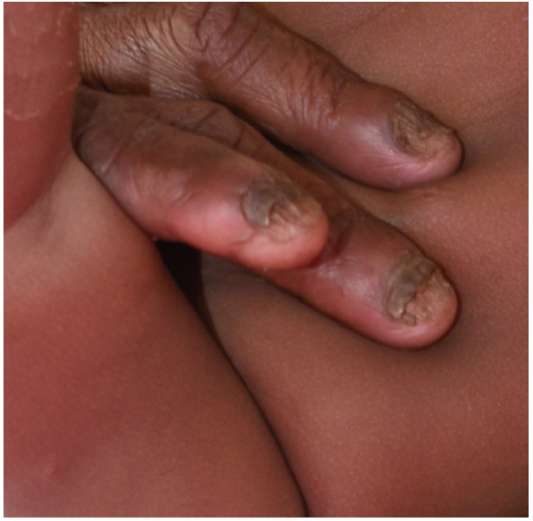 Total dystrophic onychomycosis with complete nail destruction