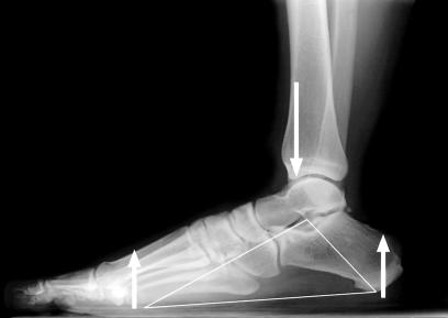 Plantar fascia truss model of the foot arch