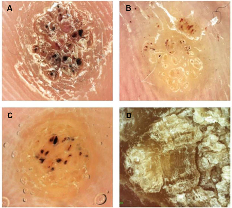 Plantar wart dermoscopy showing disrupted skin lines and capillary pattern