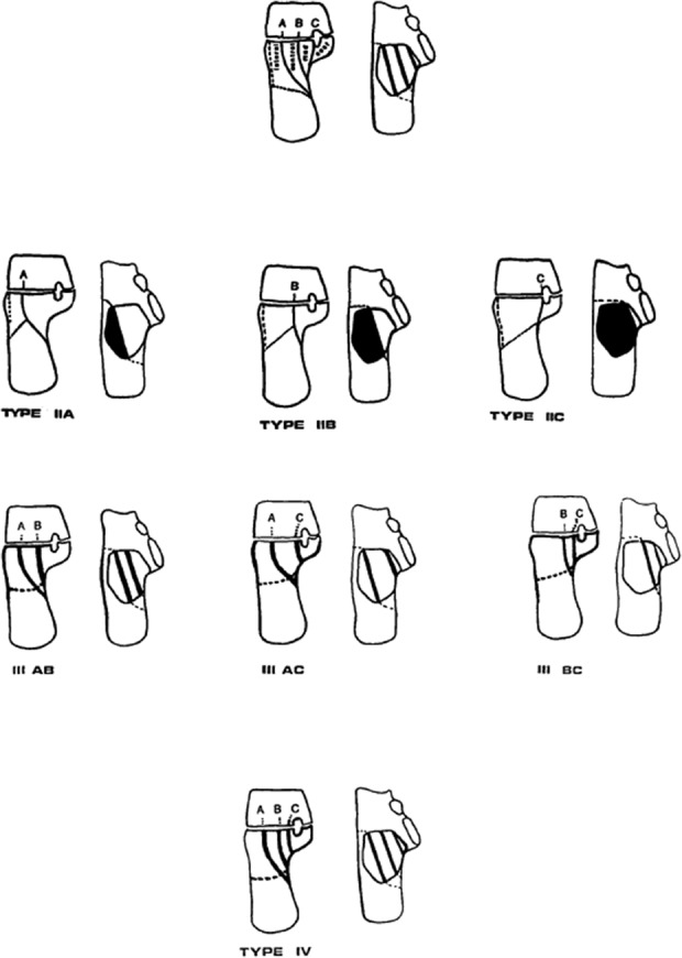 Sanders classification of calcaneus fractures on coronal CT
