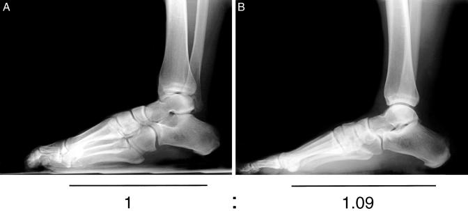 Windlass mechanism of the plantar fascia during toe dorsiflexion