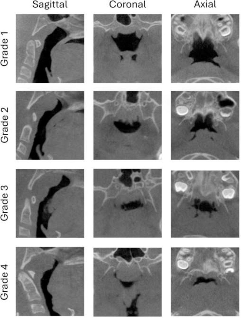 CBCT scan images showing four severity grades of upper airway obstruction from normal patent airway to complete obstruction with progressive adenoid enlargement narrowing the nasopharyngeal space