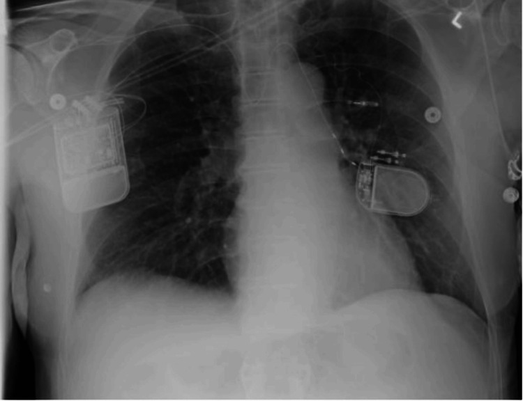 Chest X-ray showing implanted hypoglossal nerve stimulator in the right hemithorax and phrenic nerve stimulator in the left hemithorax for combined treatment of obstructive and central sleep apnea