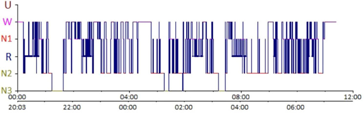 Nocturnal polysomnography recording from a narcolepsy type 1 patient showing sleep-onset REM period with REM latency of approximately 4 minutes, a hallmark diagnostic finding