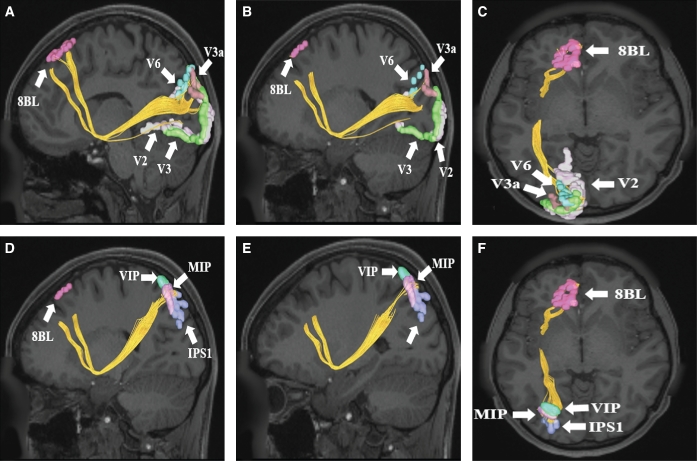 Comparison of OSA endotypic traits across nonobese OSA patients, obese patients with simple OSA, and obese patients with comorbid sleep-related hypoventilation showing differences in collapsibility, loop gain, and arousal threshold