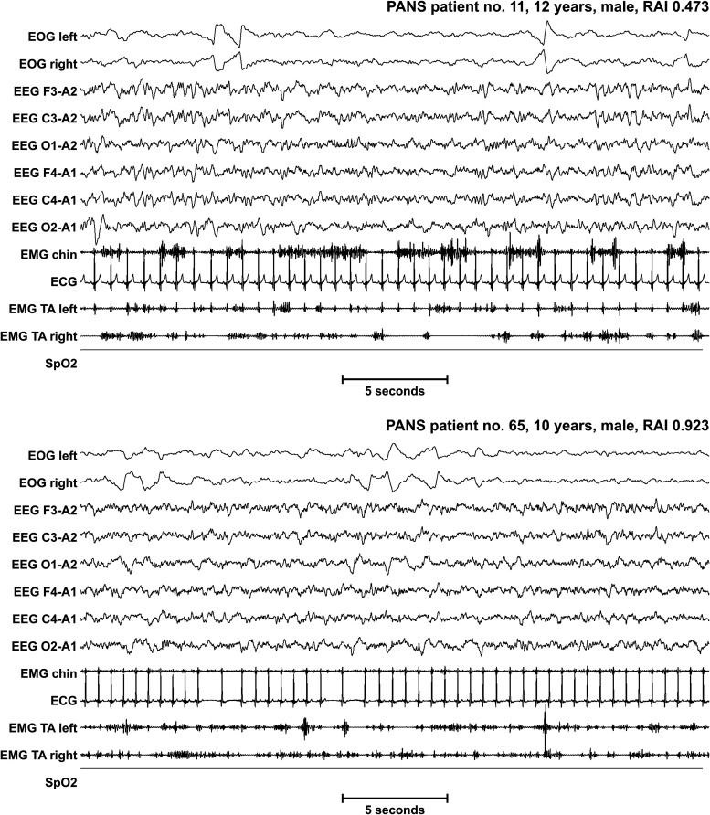 Polysomnographic recordings comparing REM sleep in a patient with impaired REM atonia showing elevated phasic chin EMG activity versus a normal control with complete muscle atonia during REM sleep