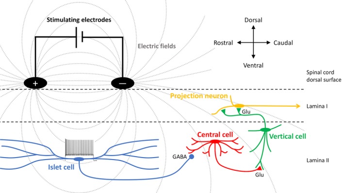 Mechanism of spinal cord stimulation showing gate control theory application