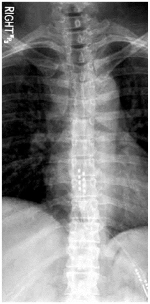 Post-implant radiograph showing spinal cord stimulator electrode leads in the thoracic epidural space