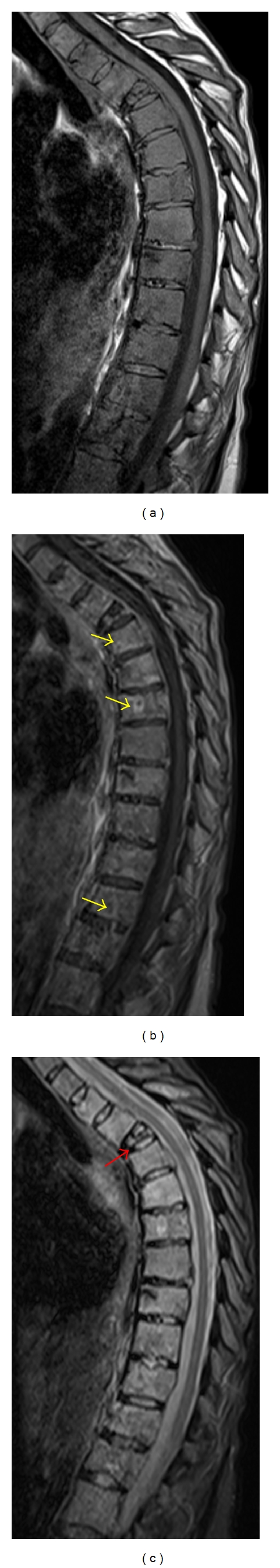 Sagittal MRI showing diffuse spinal bone metastases with vertebral compression