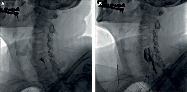 Stellate ganglion block anatomy and needle placement at C6 Chassaignac tubercle