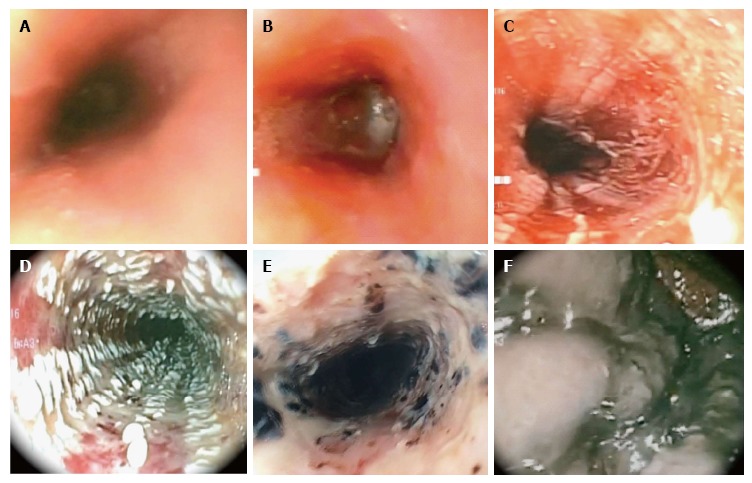 Endoscopic images showing Zargar classification grades of caustic esophageal injury from grade I erythema through grade IIIb extensive necrosis