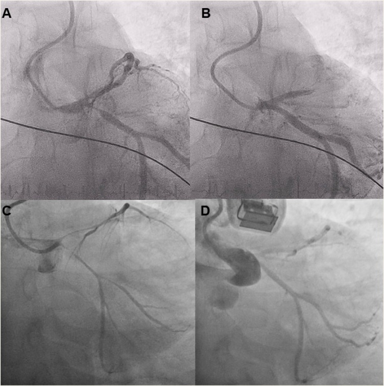 Coronary angiography and pathologic mechanisms of cocaine-induced coronary vasospasm and acute coronary syndrome