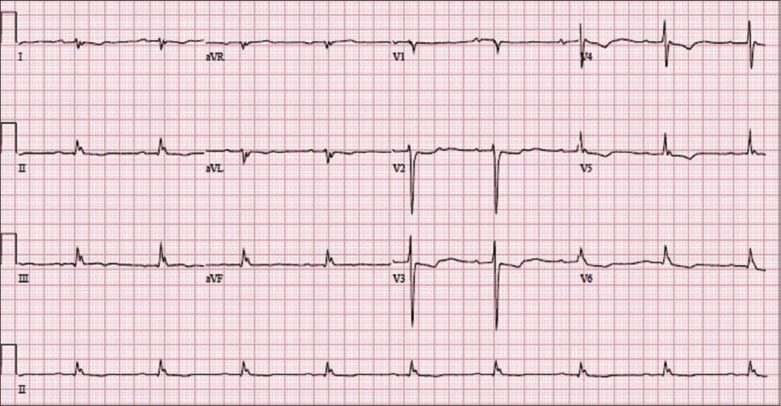Twelve-lead ECG on hospital admission showing arrhythmia pattern consistent with acute digoxin toxicity