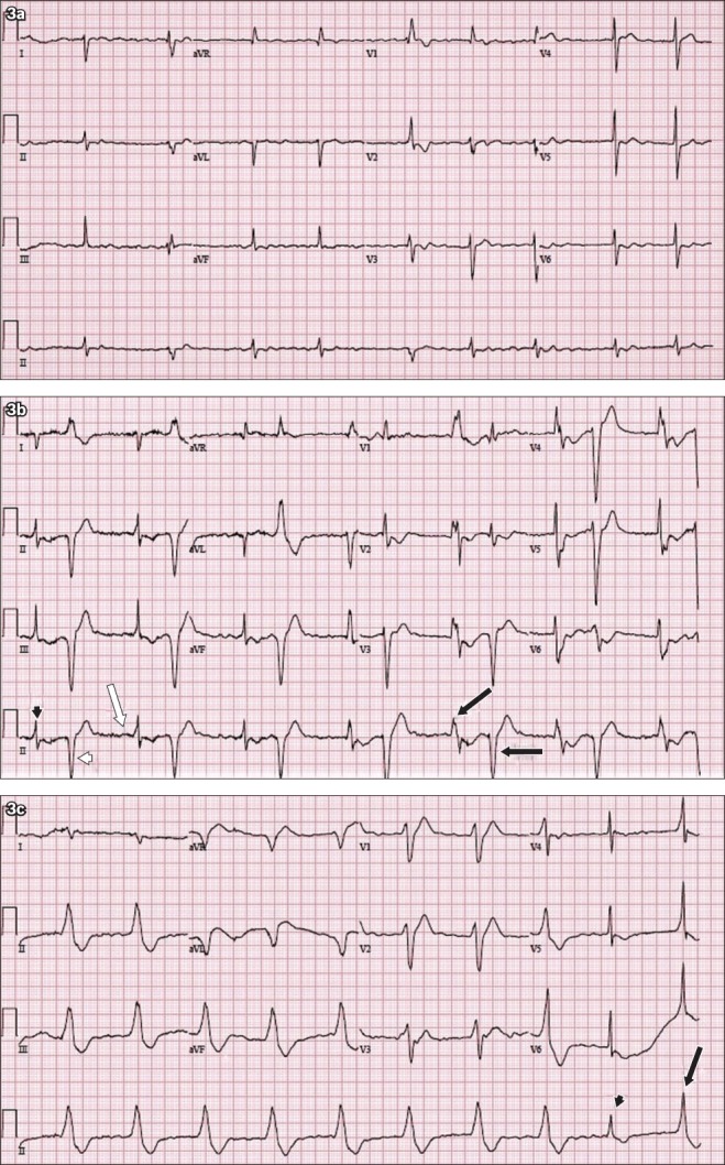 ECG findings in digoxin toxicity showing scooped ST depression, atrial tachycardia with AV block, and bidirectional ventricular tachycardia