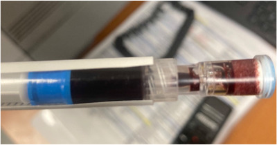 Comparison of normal arterial blood (bright red) and methemoglobinemic blood (chocolate brown) that does not turn red with oxygen exposure