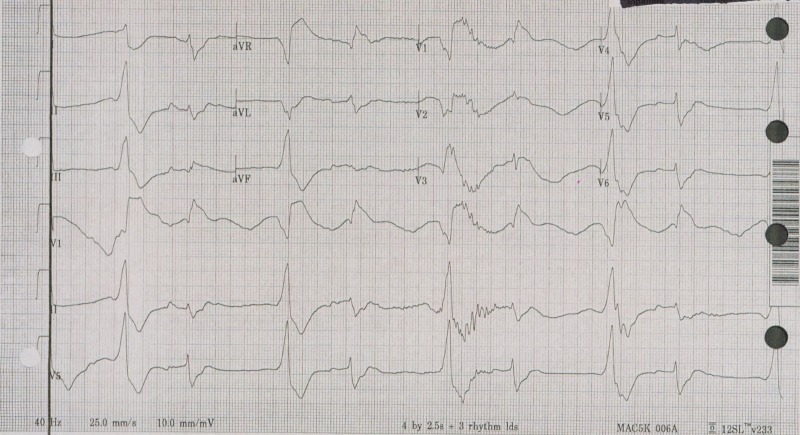 12-lead ECG showing wide QRS complex tachycardia with rightward axis deviation characteristic of tricyclic antidepressant toxicity