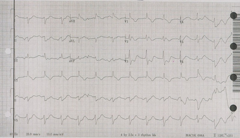 Serial ECG tracings showing progressive QRS widening in TCA toxicity before and after sodium bicarbonate treatment