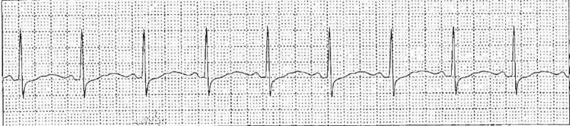 ECG tracing showing resolution of QRS widening after treatment of tricyclic antidepressant toxicity