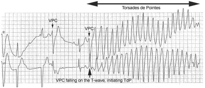 ECG tracing showing short-long-short cycle initiating torsades de pointes with characteristic twisting QRS morphology