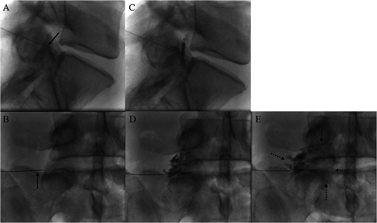 Transforaminal epidural steroid injection technique targeting the neural foramen