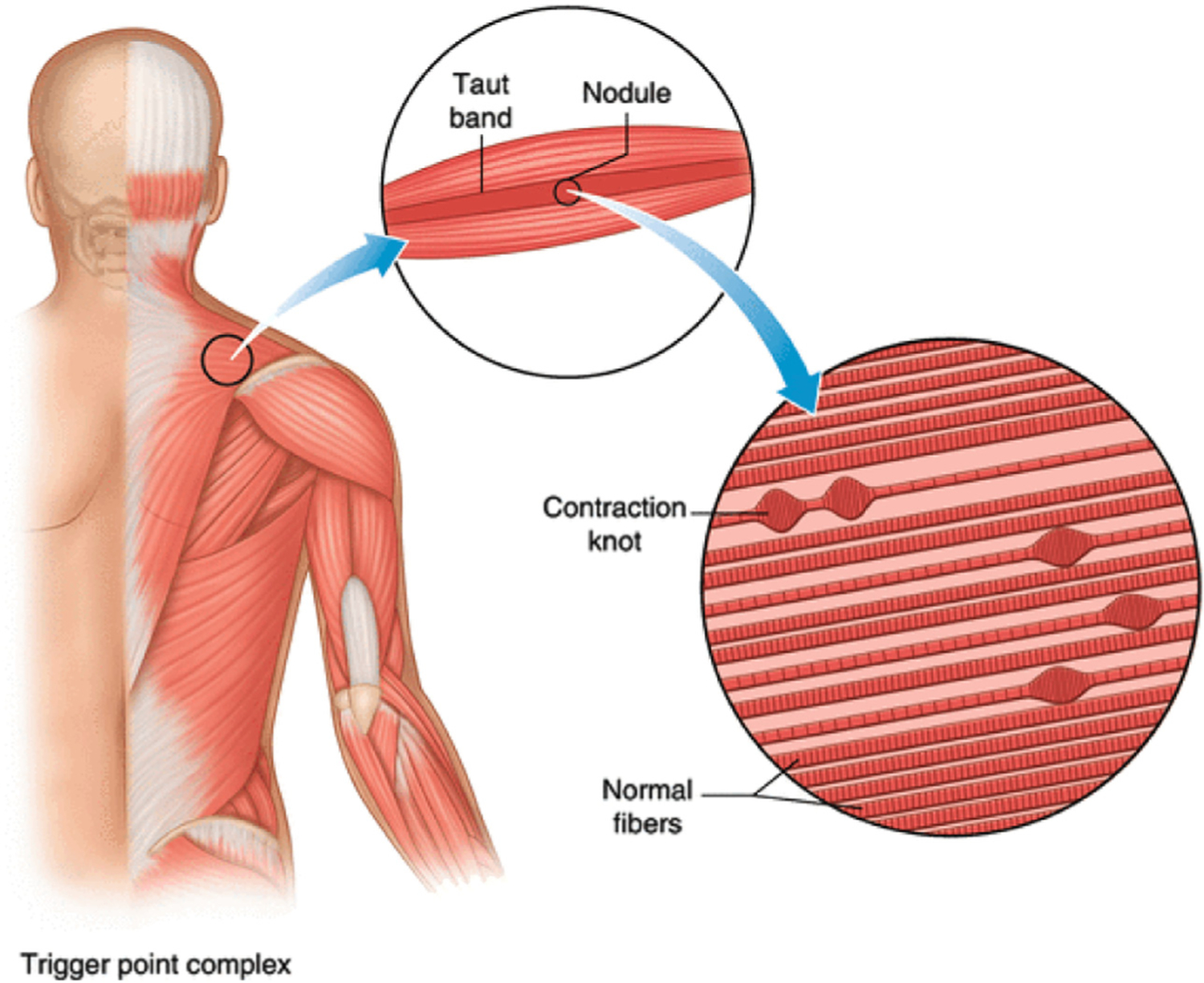 Anatomy of a myofascial trigger point showing taut band, contraction knots, and referred pain pattern