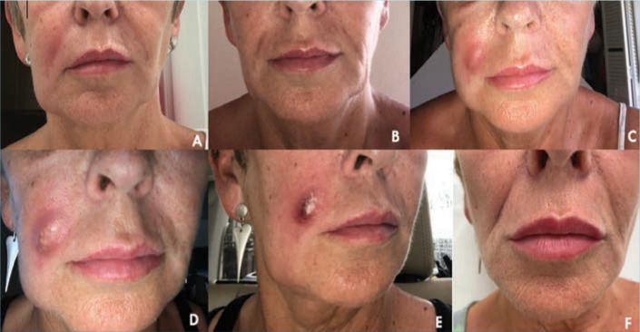 Clinical photograph series showing the progression and treatment of a cutaneous abscess from initial presentation through incision and drainage to healing, documenting erythema, fluctuance, and wound resolution over multiple days