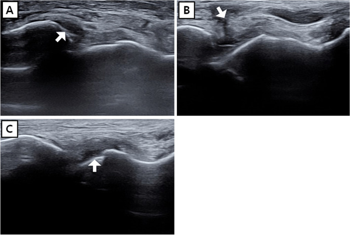 Radiographic and clinical classification of ankle fractures showing Weber classification types A, B, and C based on fibular fracture level relative to the syndesmosis