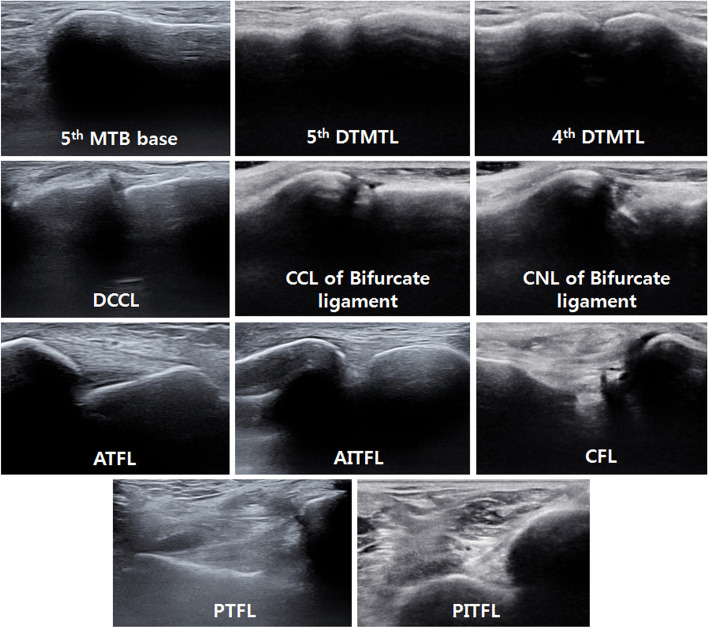 Classification of lateral ankle ligament injuries showing progression from grade I stretch injury through grade II partial tear to grade III complete rupture with associated imaging findings