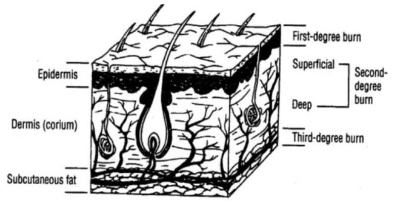 Cross-sectional diagram of skin anatomy showing burn depth classification from superficial (epidermal) through partial-thickness (dermal) to full-thickness burns, correlating depth with affected skin layers