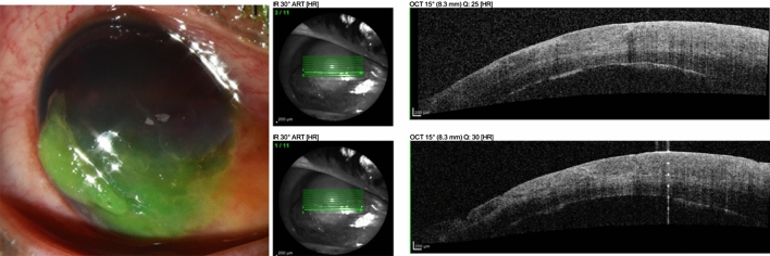 Slit lamp photograph showing a corneal abrasion highlighted by fluorescein staining under cobalt blue light, revealing the epithelial defect as a bright green area